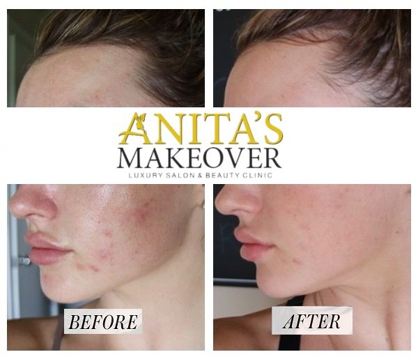 face PRP Results