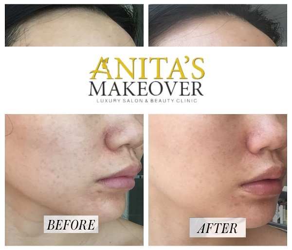 face PRP Results Gurgaon